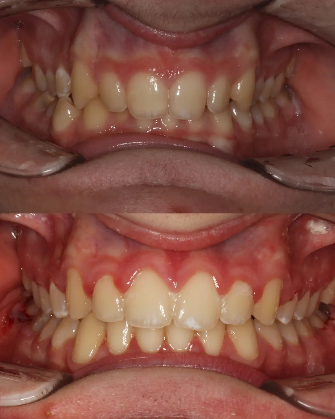 Before and after: upper and lower views of a patient's teeth treated with braces (case 5 of 7)