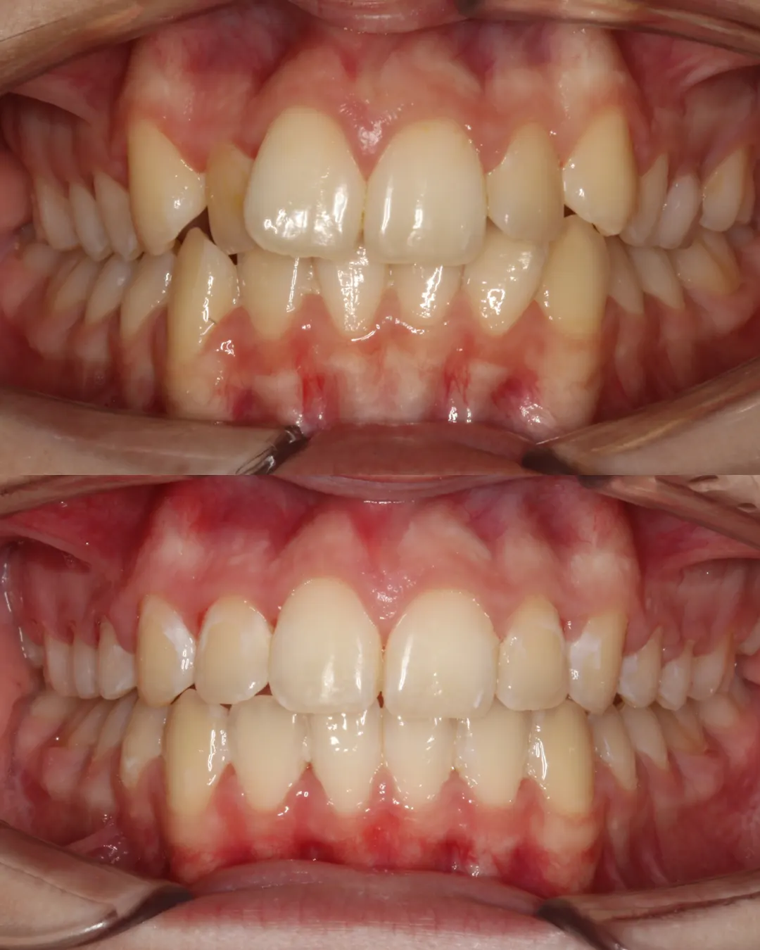 Before and after: upper and lower views of a patient's teeth treated with braces (case 2 of 7)