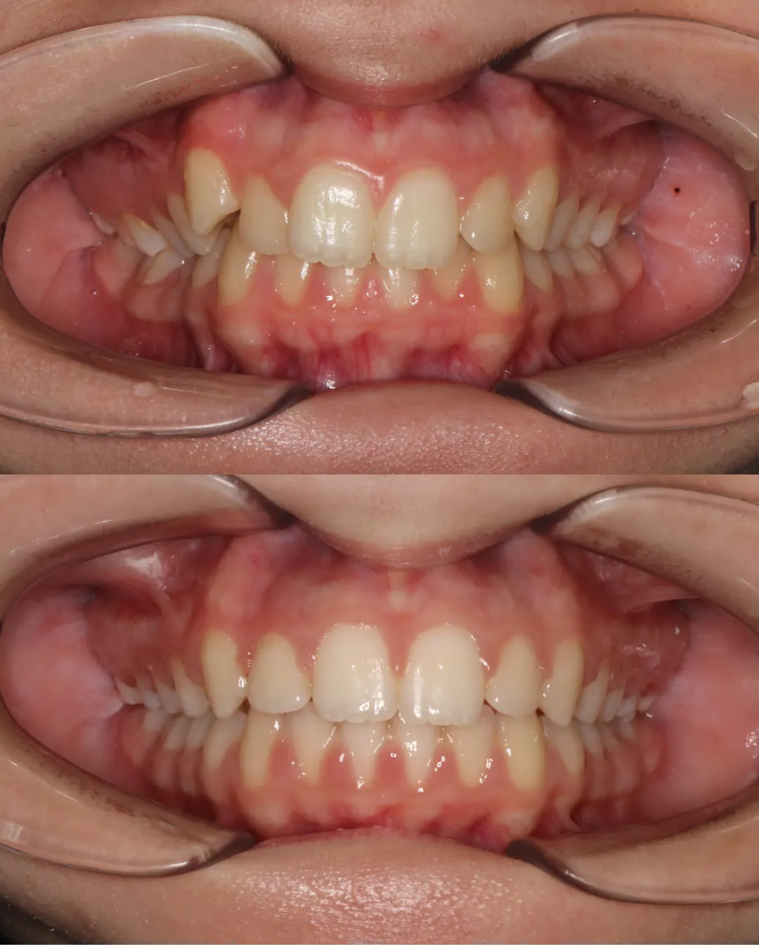 Before and after: upper and lower views of a patient's teeth treated with braces (case 1 of 7)