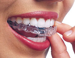 Types of braces