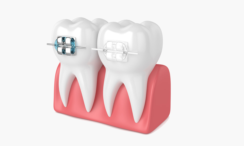 Types of braces